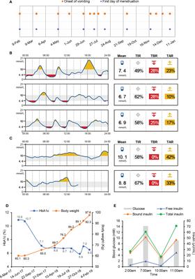 Type 1 diabetes complicated with cyclic vomiting syndrome and exogenous insulin antibody syndrome: A case report